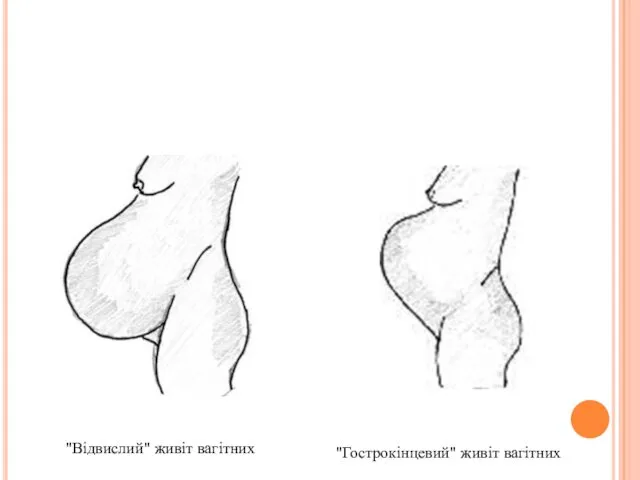 "Гострокінцевий" живіт вагітних "Відвислий" живіт вагітних