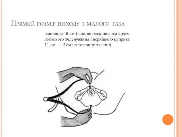 Прямий розмір виходу з малого таза відповідає 9 см (відстані між нижнім краєм