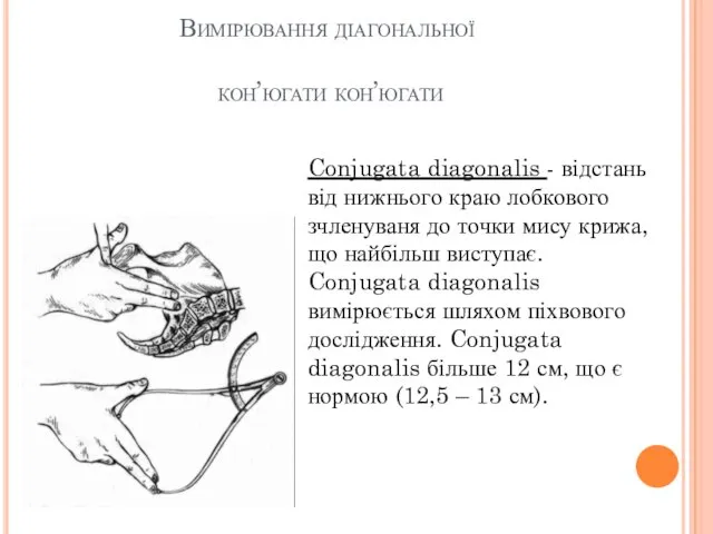 Вимірювання діагональної кон’югати кон’югати Conjugata diagonalis - відстань від нижнього