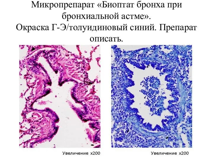 Микропрепарат «Биоптат бронха при бронхиальной астме». Окраска Г-Э/толуидиновый синий. Препарат описать.