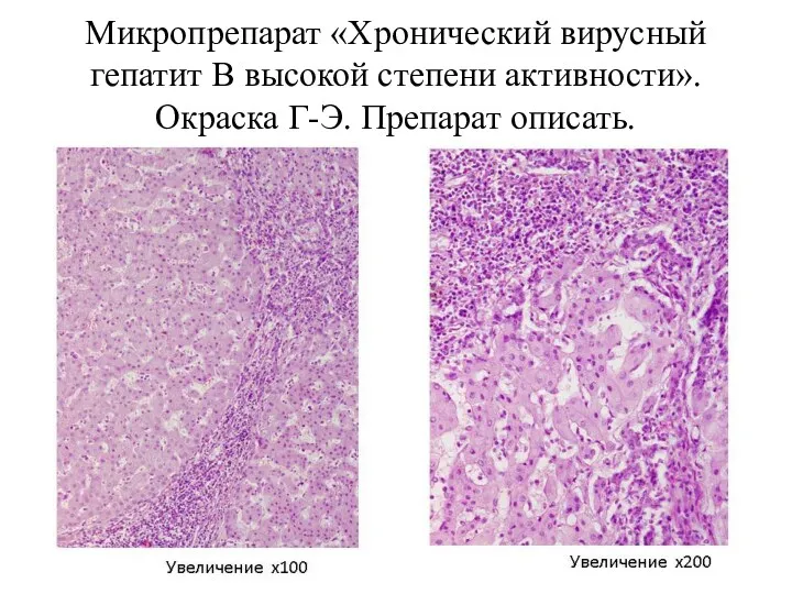 Микропрепарат «Хронический вирусный гепатит В высокой степени активности». Окраска Г-Э. Препарат описать.