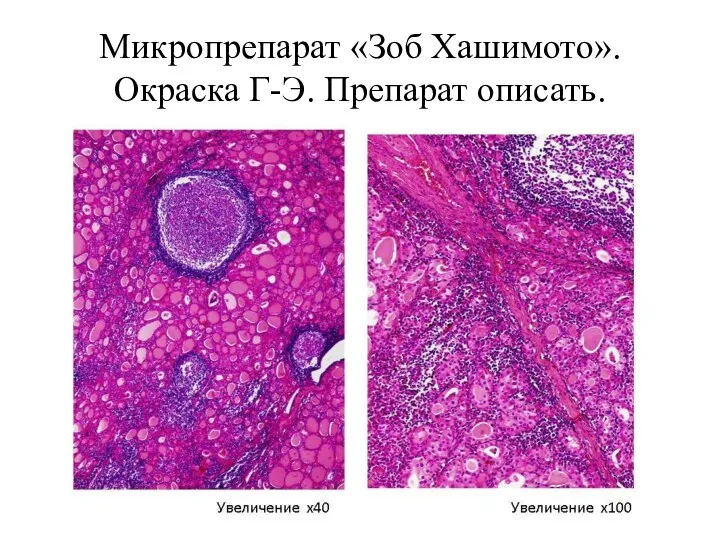 Микропрепарат «Зоб Хашимото». Окраска Г-Э. Препарат описать.