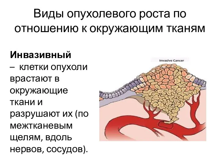 Виды опухолевого роста по отношению к окружающим тканям Инвазивный –