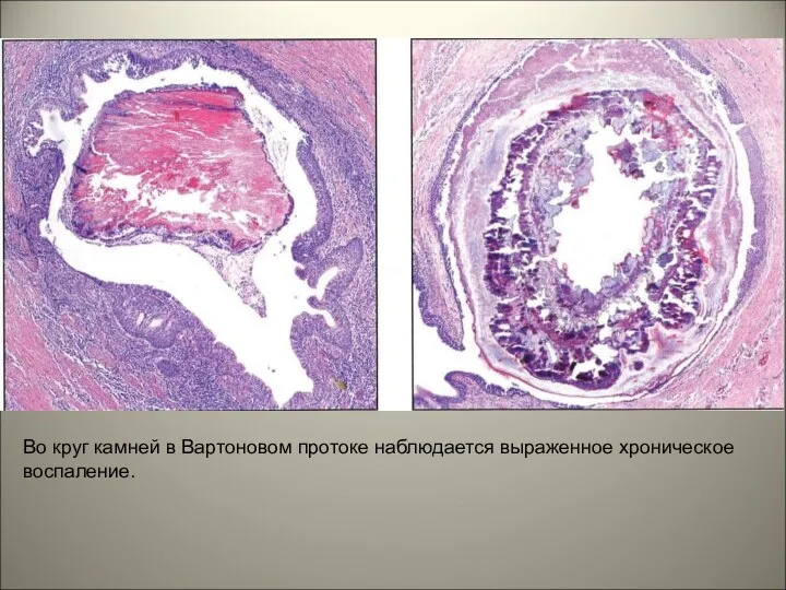 Во круг камней в Вартоновом протоке наблюдается выраженное хроническое воспаление.