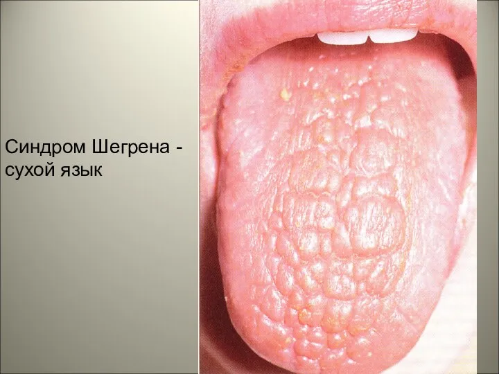 Синдром Шегрена - сухой язык