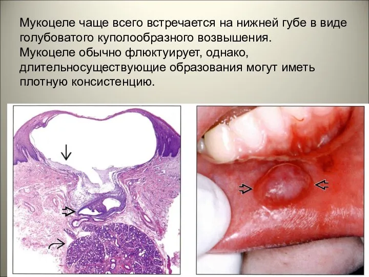 Мукоцеле чаще всего встречается на нижней губе в виде голубоватого куполообразного возвышения. Мукоцеле
