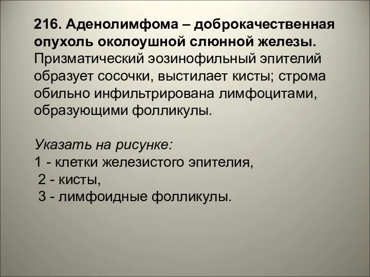 216. Аденолимфома – доброкачественная опухоль околоушной слюнной железы. Призматический эозинофильный