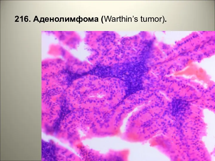 216. Аденолимфома (Warthin’s tumor).