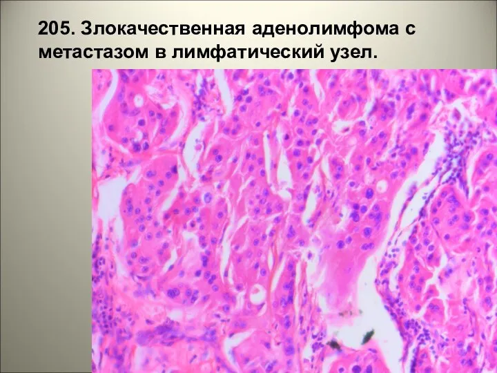 205. Злокачественная аденолимфома с метастазом в лимфатический узел.