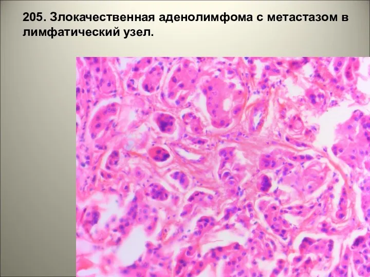 205. Злокачественная аденолимфома с метастазом в лимфатический узел.