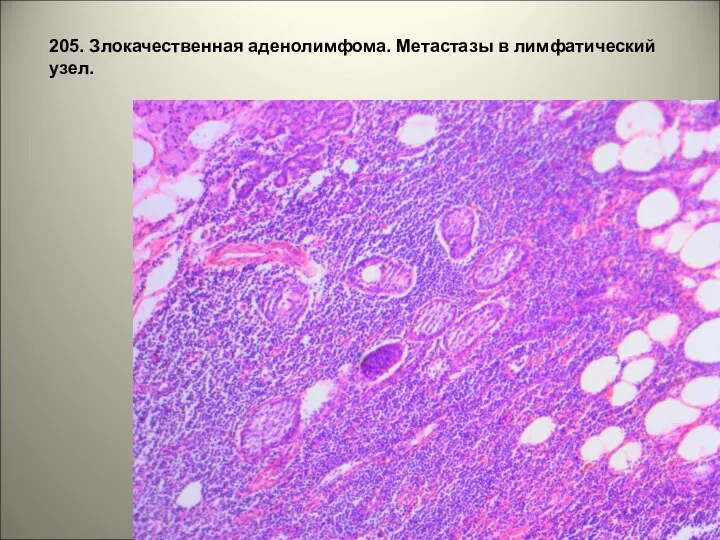 205. Злокачественная аденолимфома. Метастазы в лимфатический узел.
