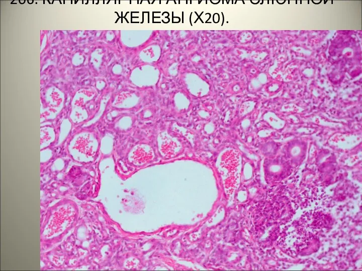 206. КАПИЛЛЯРНАЯ АНГИОМА СЛЮННОЙ ЖЕЛЕЗЫ (Х20). .