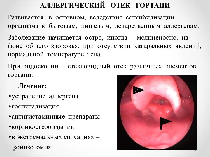 АЛЛЕРГИЧЕСКИЙ ОТЕК ГОРТАНИ Развивается, в основном, вследствие сенсибилизации организма к