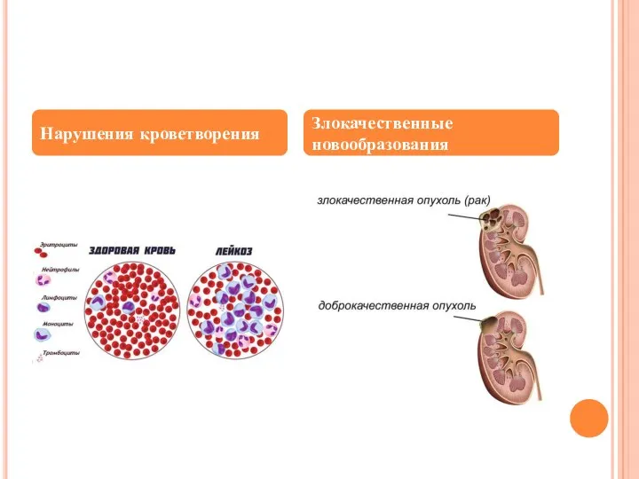 Нарушения кроветворения Злокачественные новообразования