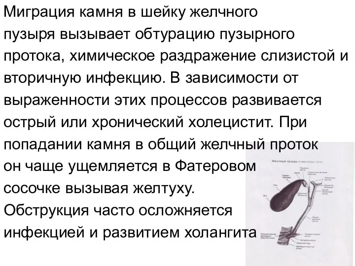 Миграция камня в шейку желчного пузыря вызывает обтурацию пузырного протока,