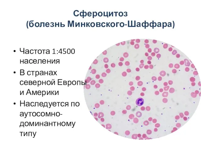 Сфероцитоз (болезнь Минковского-Шаффара) Частота 1:4500 населения В странах северной Европы и Америки Наследуется по аутосомно-доминантному типу