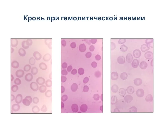 Кровь при гемолитической анемии