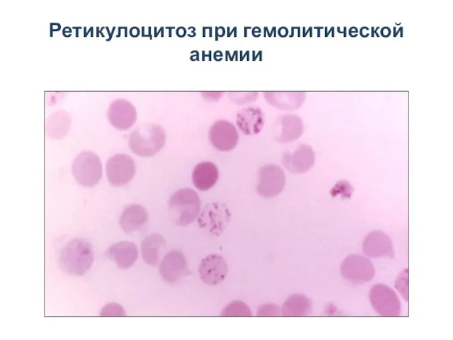 Ретикулоцитоз при гемолитической анемии