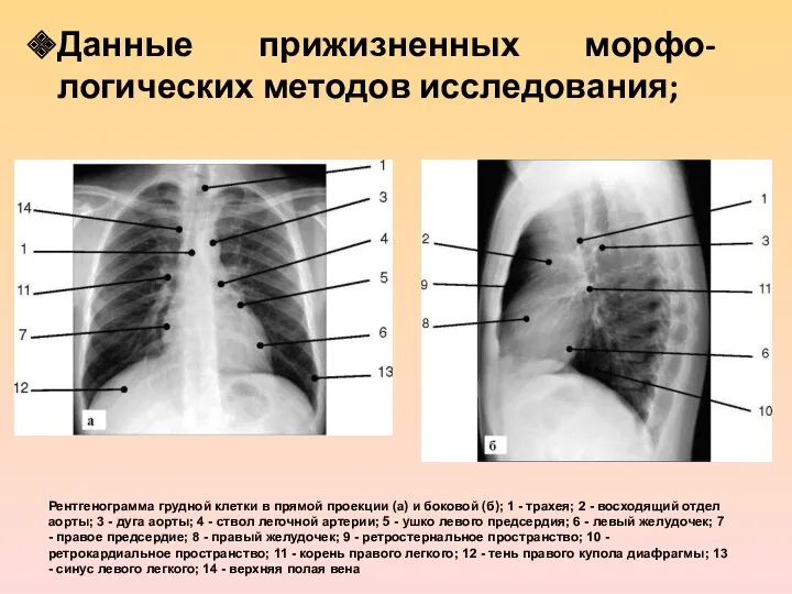 Данные прижизненных морфо-логических методов исследования; Рентгенограмма грудной клетки в прямой