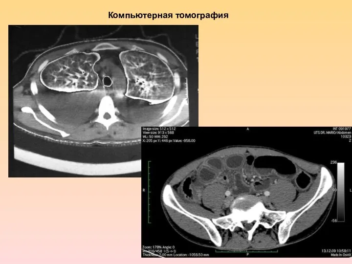 Компьютерная томография