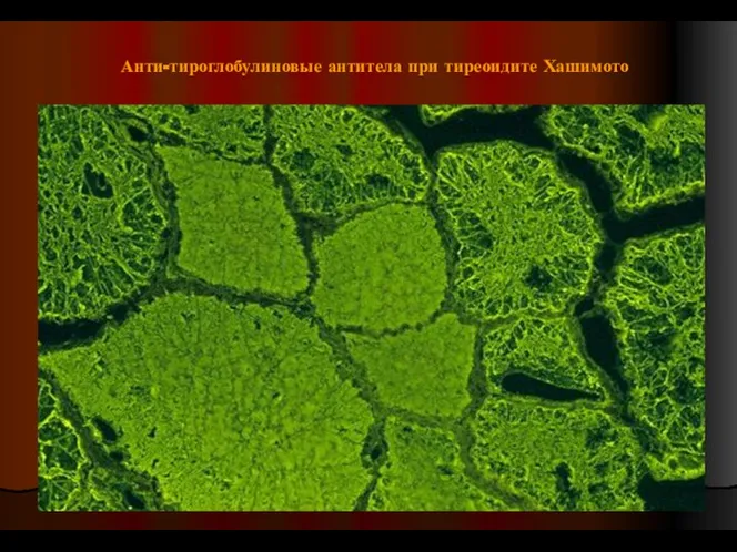 Анти-тироглобулиновые антитела при тиреоидите Хашимото