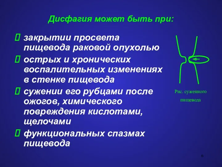 Дисфагия может быть при: закрытии просвета пищевода раковой опухолью острых