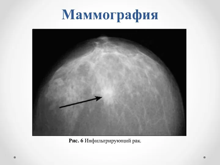 Маммография Рис. 6 Инфильтрирующий рак.