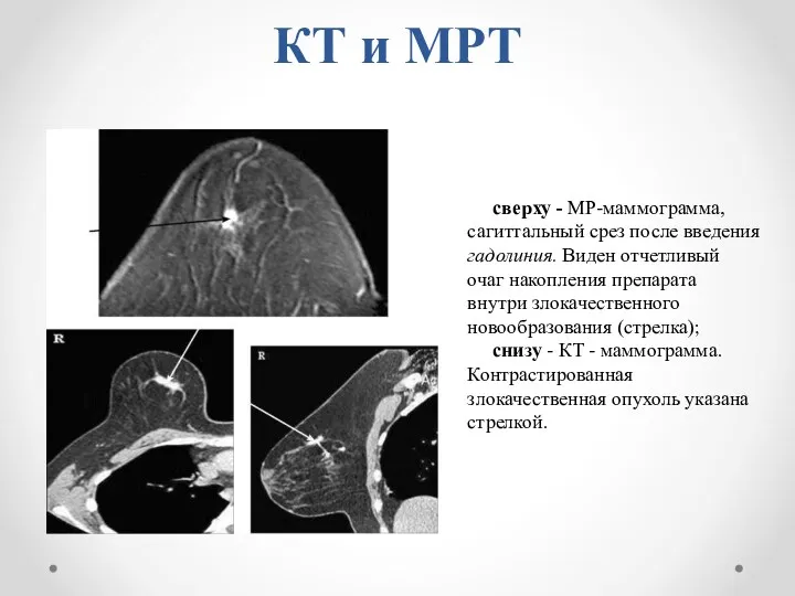 КТ и МРТ сверху - МР-маммограмма, сагиттальный срез после введения