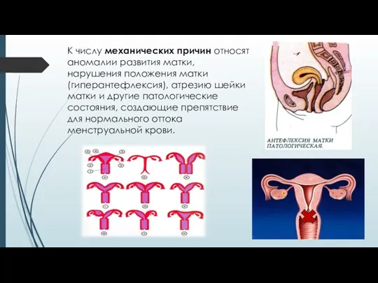 К числу механических причин относят аномалии развития матки, нарушения положения матки (гиперантефлексия), атрезию