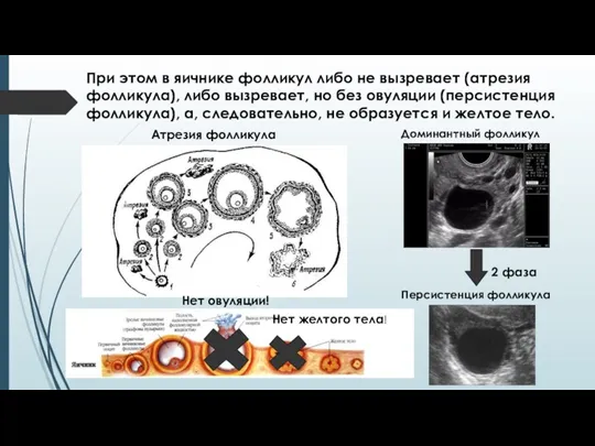 При этом в яичнике фолликул либо не вызревает (атрезия фолликула),
