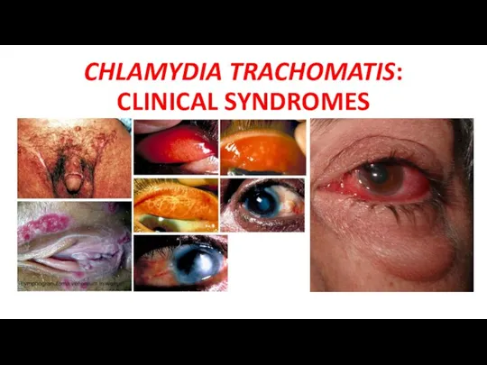 CHLAMYDIA TRACHOMATIS: CLINICAL SYNDROMES