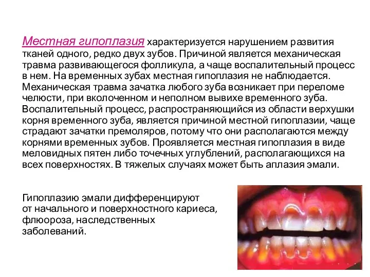 Местная гипоплазия характеризуется нарушением развития тканей одного, редко двух зубов.