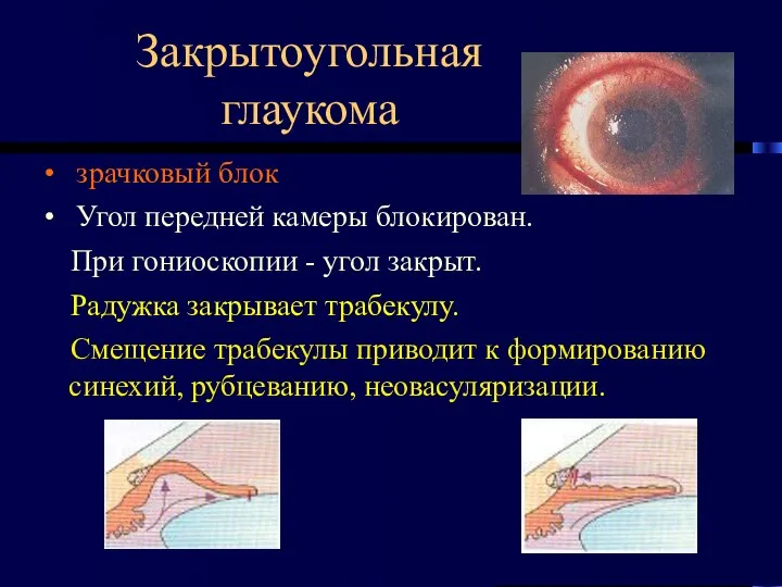 Закрытоугольная глаукома зрачковый блок Угол передней камеры блокирован. При гониоскопии