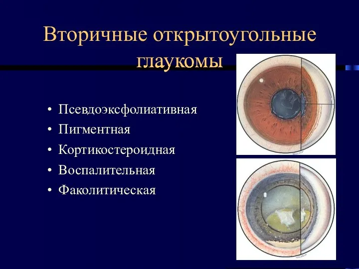 Вторичные открытоугольные глаукомы Псевдоэксфолиативная Пигментная Кортикостероидная Воспалительная Факолитическая