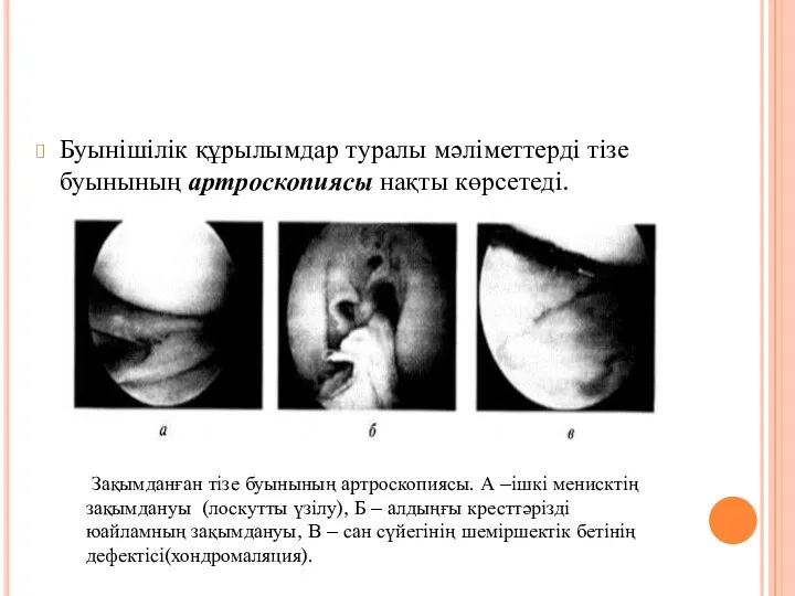 Буынішілік құрылымдар туралы мәліметтерді тізе буынының артроскопиясы нақты көрсетеді. Зақымданған