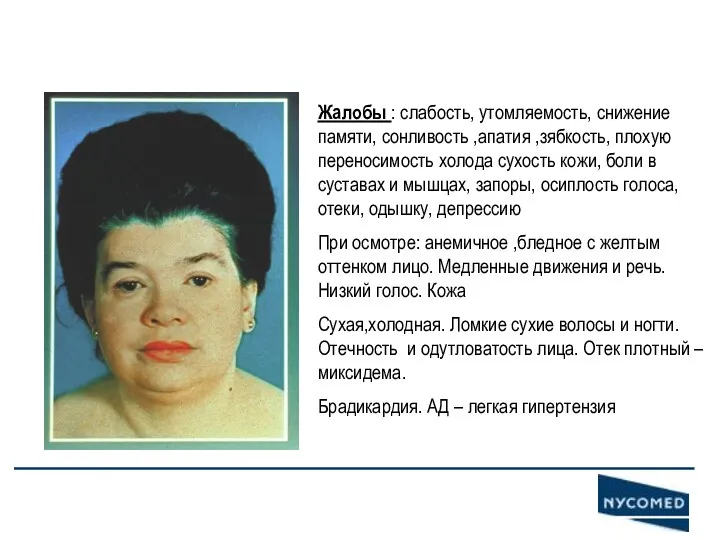 Гипотиреоз Жалобы : слабость, утомляемость, снижение памяти, сонливость ,апатия ,зябкость,