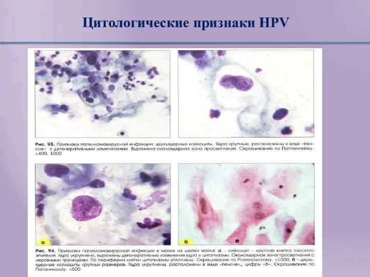 Цитологические признаки HPV