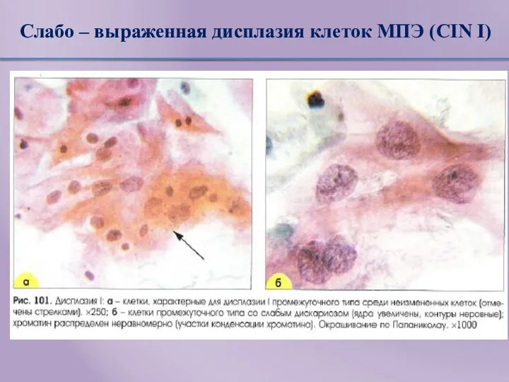 Слабо – выраженная дисплазия клеток МПЭ (CIN I)