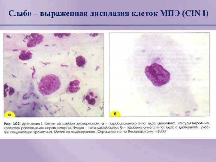 Слабо – выраженная дисплазия клеток МПЭ (CIN I)