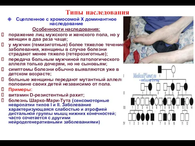 Типы наследования Сцепленное с хромосомой Х доминантное наследование Особенности наследования: