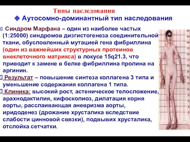 Типы наследования Синдром Марфана – один из наиболее частых (1:25000)