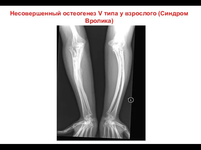 Несовершенный остеогенез V типа у взрослого (Синдром Вролика)