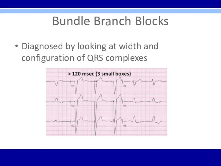 Bundle Branch Blocks Diagnosed by looking at width and configuration of QRS complexes