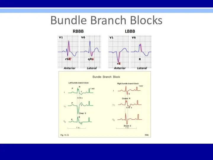 Bundle Branch Blocks