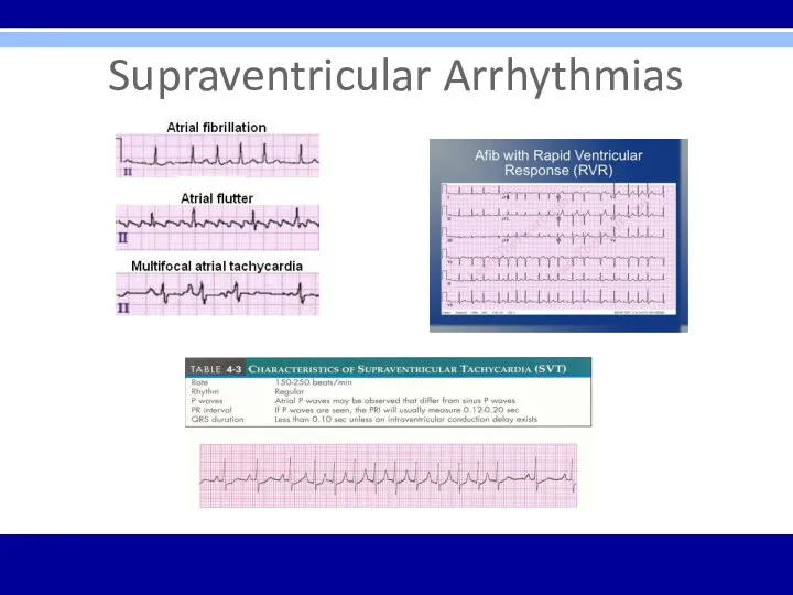 Supraventricular Arrhythmias