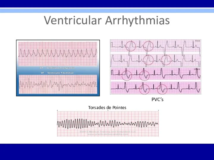 Ventricular Arrhythmias Torsades de Pointes PVC’s