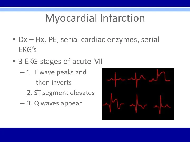 Myocardial Infarction Dx – Hx, PE, serial cardiac enzymes, serial