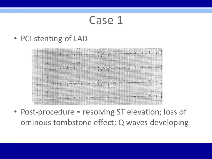 Case 1 PCI stenting of LAD Post-procedure = resolving ST
