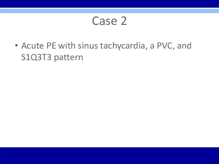 Case 2 Acute PE with sinus tachycardia, a PVC, and S1Q3T3 pattern