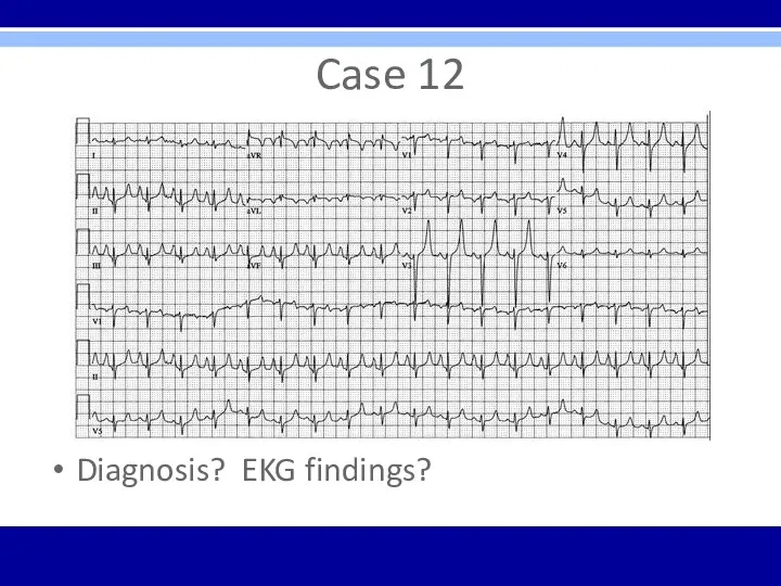 Case 12 Diagnosis? EKG findings?